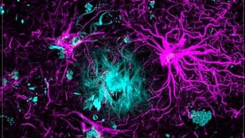 Maladie d’Alzheimer: prévenir, c’est possible?
